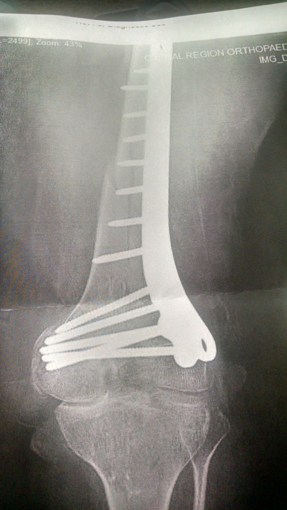 X-ray photo of a knee and femur. The femur is broken and there is a metal plate along the side of the bone with 13 screws.